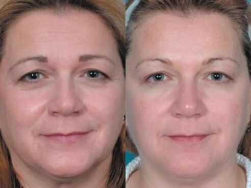 fotografije prije i poslije pomlađivanja kože plazmom