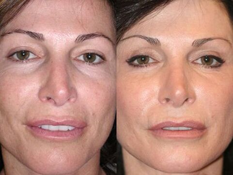prije i poslije pomlađivanja kože plazmom