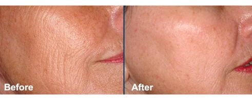 Koža lica prije i poslije postupka laserskog pomlađivanja