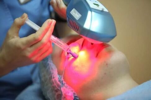 Laserska biorevitalizacija kože lica
