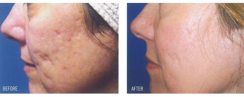 Prije i nakon nanošenja laserskog uređaja na kožu s ožiljcima