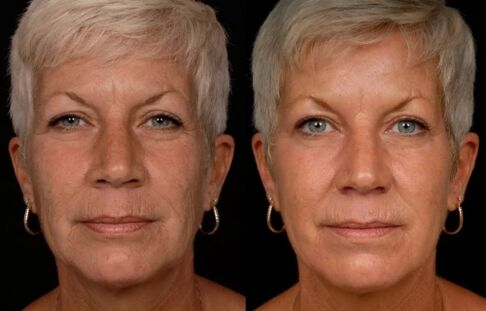 Rezultat laserskog tretmana kože lica - smanjenje bora