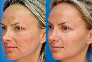 fotografija prije i poslije pomlađivanja kože uređajem